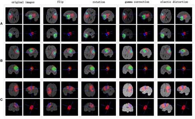 Nested Dilation Networks for Brain Tumor Segmentation Based on Magnetic Resonance Imaging